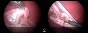 雌犬の内視鏡下避妊手術2