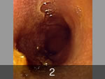 内視鏡検査によって認められた腸粘膜の不整と浮腫
